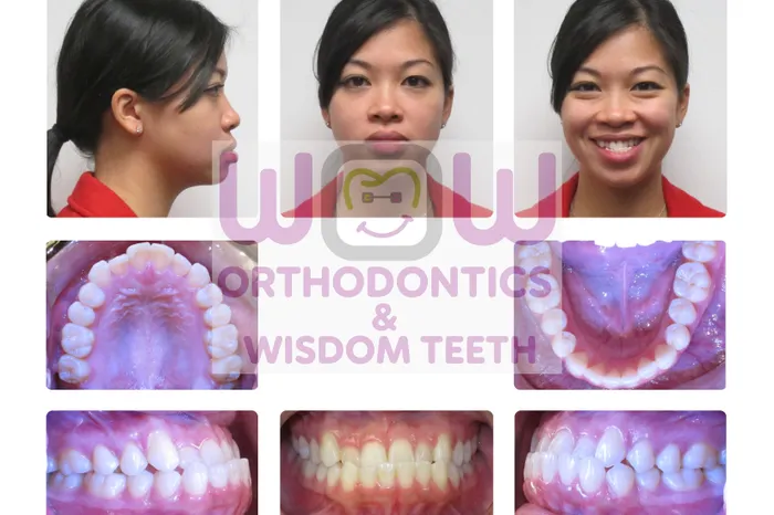 Crossbite Correction - After