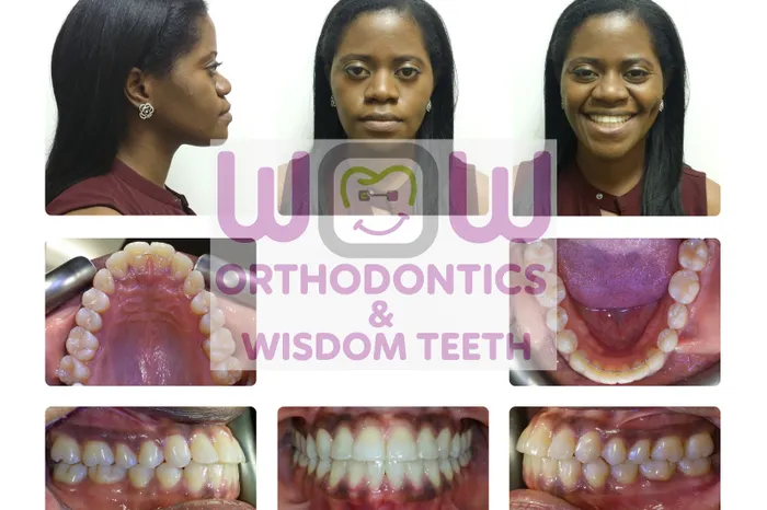 Crossbite Correction - After