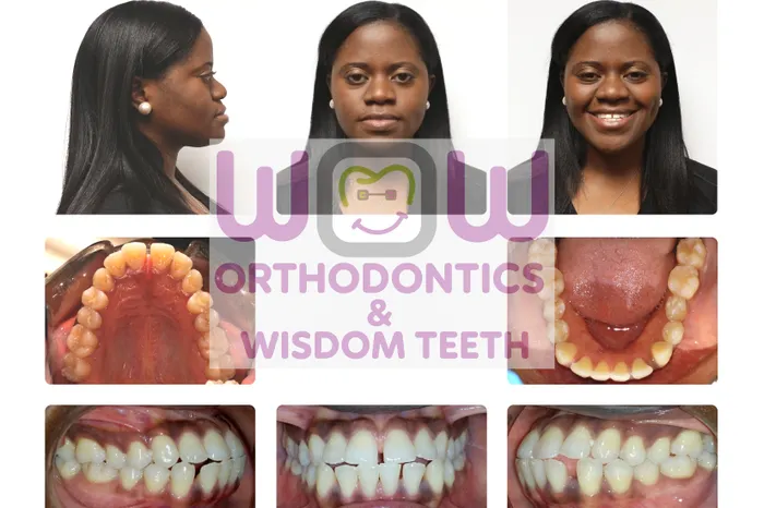 Crossbite Correction - Before