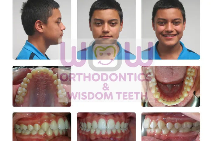 Overbite Treatment - After