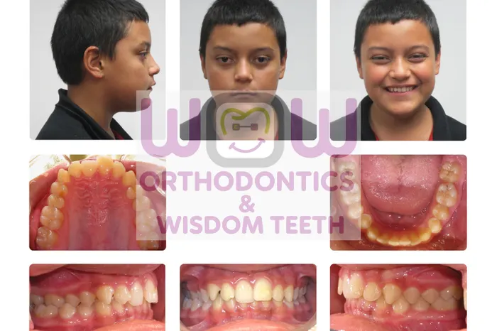 Overbite Treatment - Before