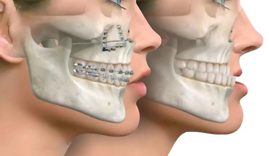 Orthognathic (Jaw) Surgery Coordination