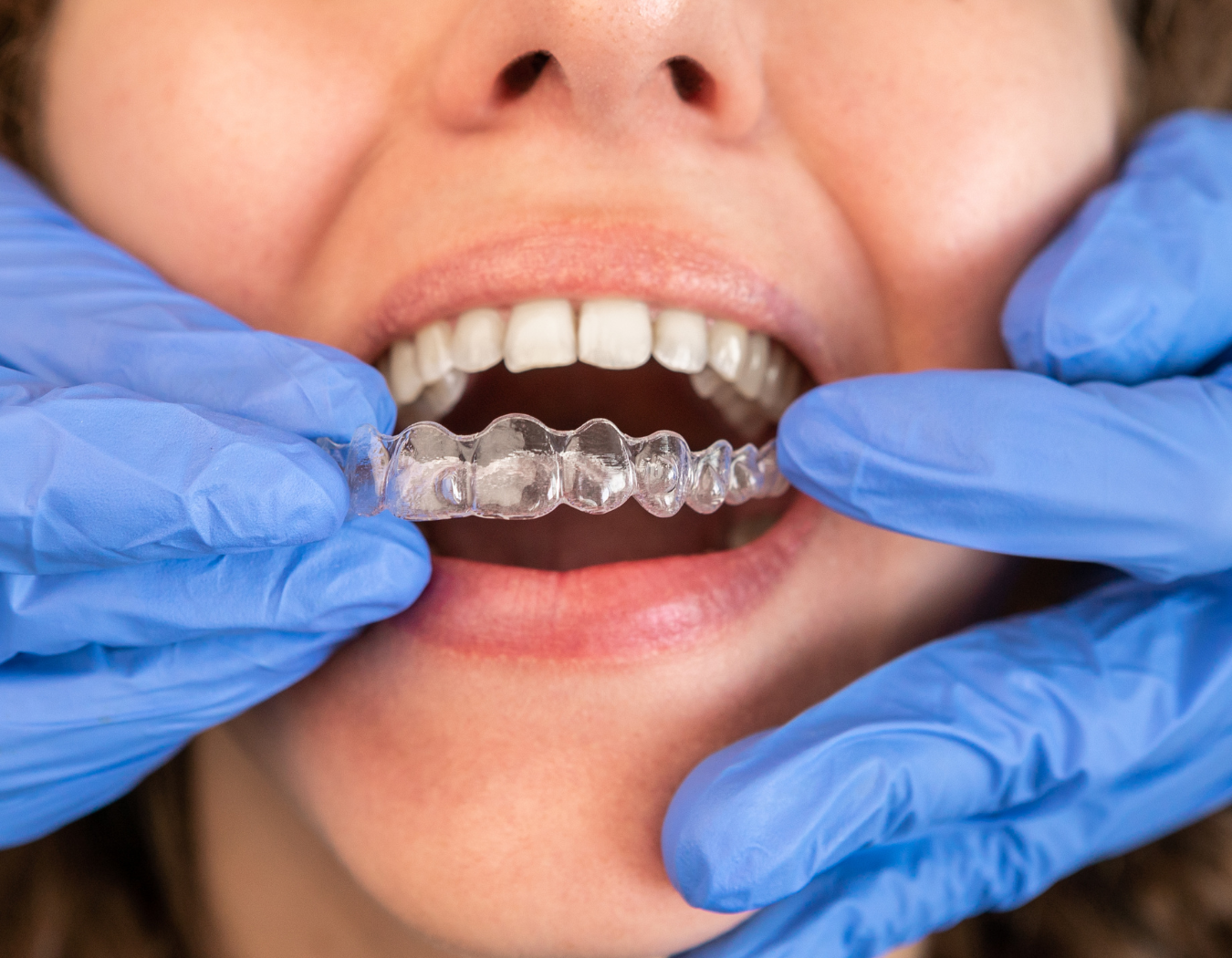 Clear Aligners & Invisalign