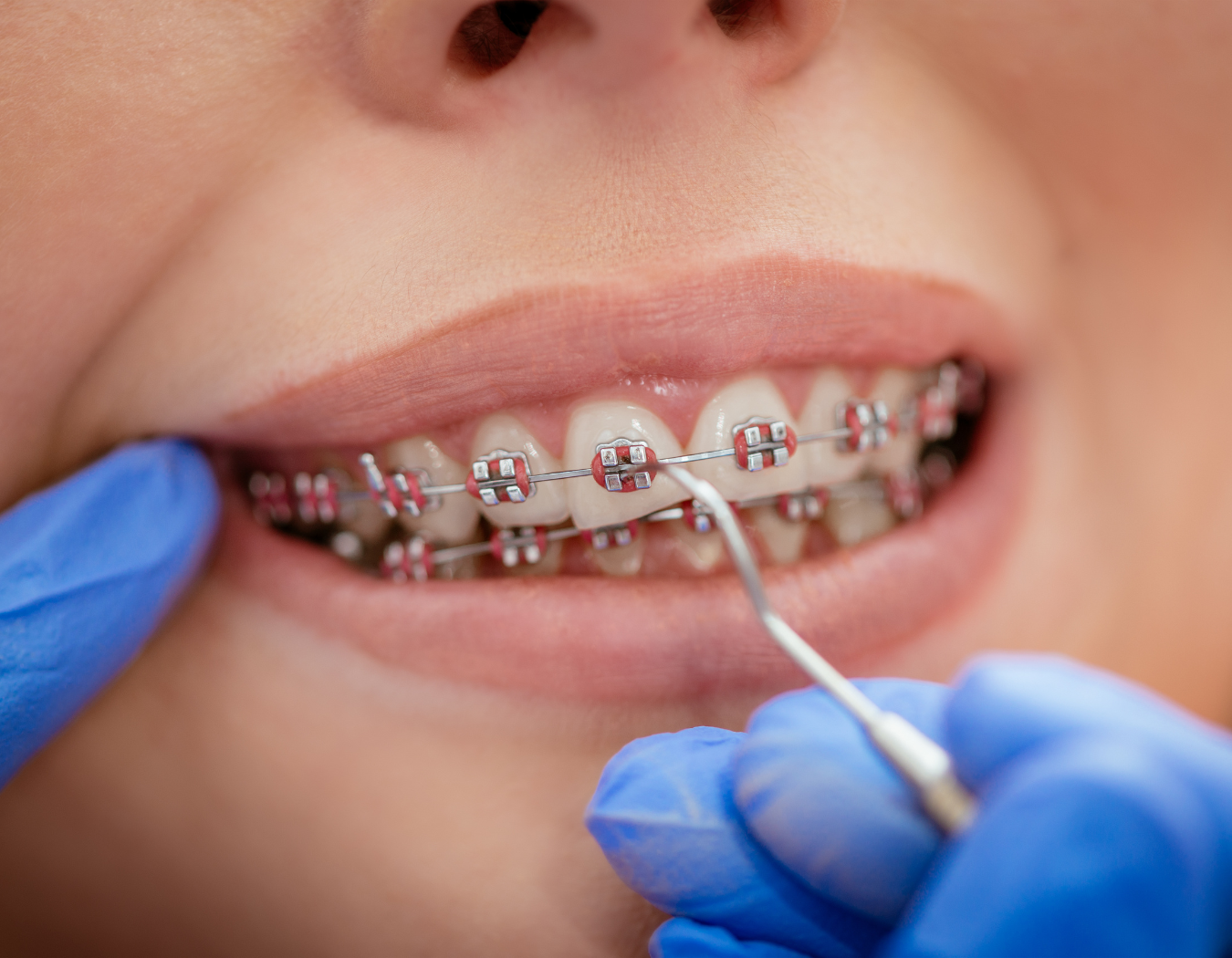 Metal & Ceramic Braces