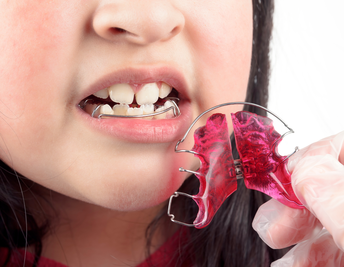 Retainers & Night Guards